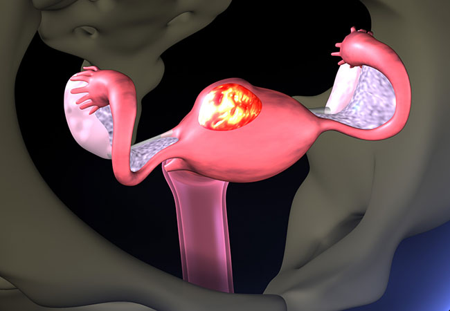 الأورام الليفية - الورم الليفي الرحمي: الأسباب والأعراض والتشخيص والعلاج - نمو غير طبيعي يتطور في رحم المرأة أو على رحمها