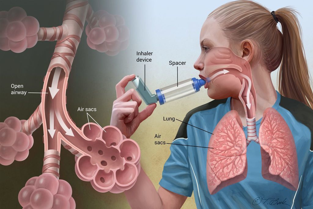 أسباب الإصابة بالربو أعراض الإصابة بالربو التشخيص العلاج الأمراض التنفسية المزمنة الطرق الهوائية الحساسية المفرطة استجابة تحسسية