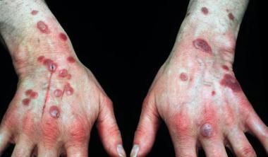 الحمامى المرتفعة الدائمة الأسباب والاعراض والتشخيص والعلاج علاج الحمامى المرتفعة الدائمة التهاب الأوعية الناخر ظهر اليدين المفاصل