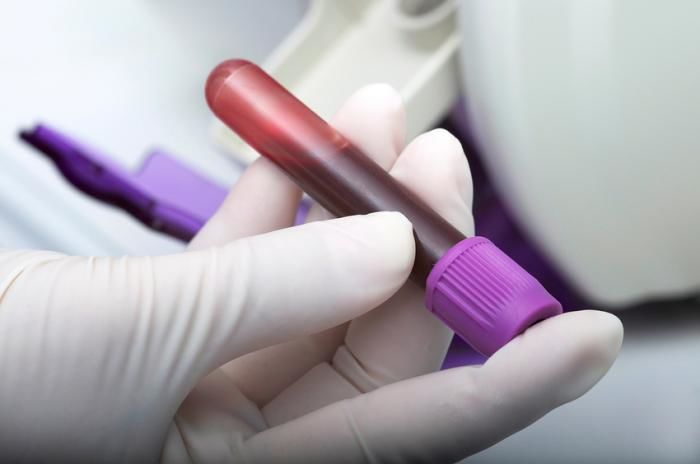 متلازمة أضداد الفوسفوليبيد أسباب متلازمة أضداد الفوسفوليبيد الأعراض التشخيص العلاج الحمل الدم الشرايين الأوعية الدموية أجسام مضادة