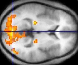 تظهر بيانات التصوير بالرنين المغناطيسي الوظيفي مناطق النشاط العصبي بالدماغ (باللون الأصفر والأحمر) استجابةً لمحفز بصري.