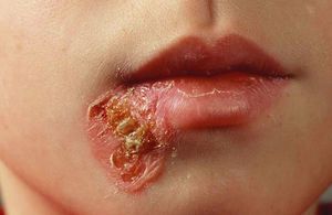القوباء التهاب جلدي معدٍ بشدة يصيب الأطفال المكورات العنقودية التهاب في الجلد آفات جلدية فقاعات متوسطة إلى كبيرة ومملوءة بالسائل 