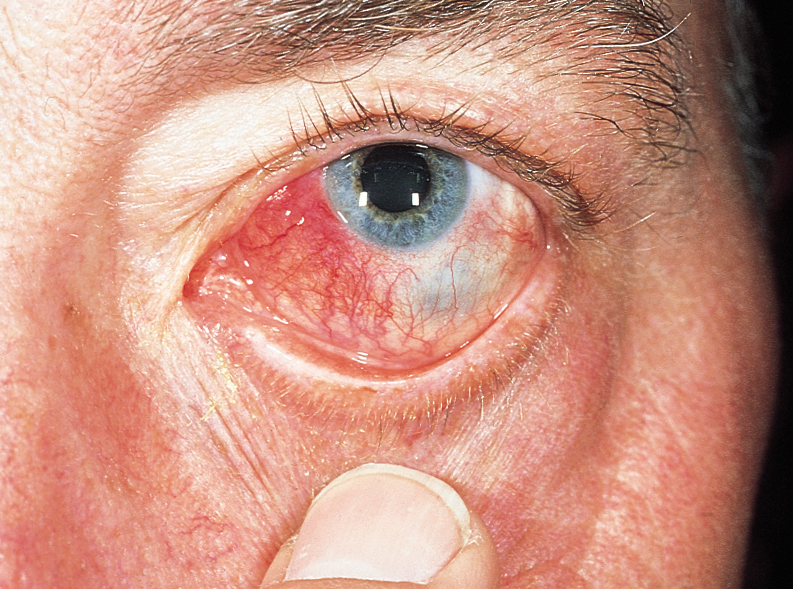 التهاب الصلبة: الأسباب والأعراض والتشخيص والعلاج - ما هو سبب التهاب الطبقة الخارجية للعين - ألم في المنطقة البيضاء من العين