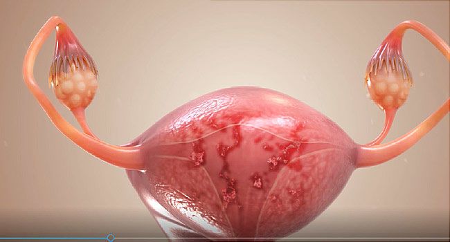 الانتباذ البطاني الرحمي: الأسباب والأعراض والتشخيص والعلاج انغراسات بطانية رحمية منشؤها النسيج الموجود في باطن الرحم الدورة الطمثية