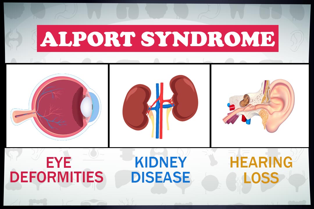 متلازمة ألبورت: الأسباب والأعراض والتشخيص والعلاج - مرض يدمر الأوعية الدموية الدقيقة في الكليتين - مرض الكلية والقصور الكلوي