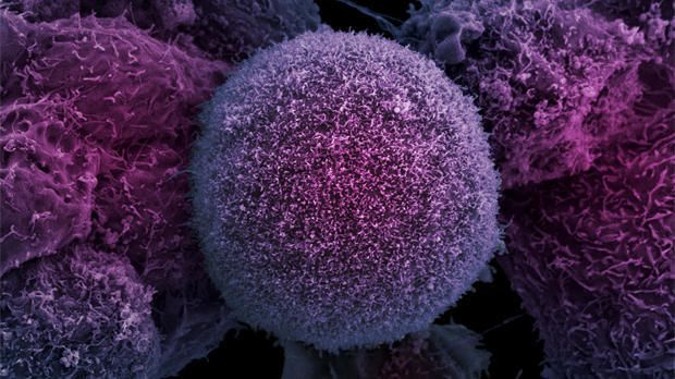 معدن من كويكب يحارب الخلايا السرطانية الإيريديوم