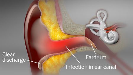 التهاب الأذن الخارجية Otitis externa: الأسباب والأعراض والتشخيص والعلاج احمرار وتورم لقناة الأذن الخارجية فقدان السمع المؤقت