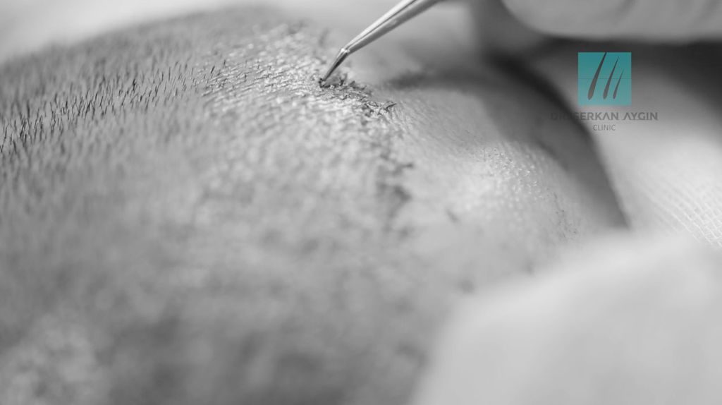 تقنيات زراعة الشعر المتقدمة