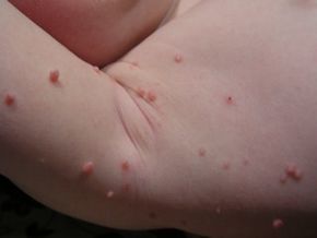 المليساء المعدية Molluscum contagiosum الأسباب والأعراض والتشخيص والعلاج خمج جلدي يسببه فيروس المليساء المعدية آفات جلدية تصيب الطبقات العليا من الجلد