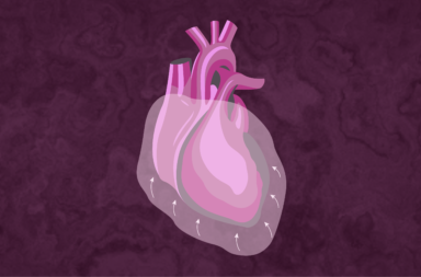 انصباب التامور: الأسباب والعلاج - وجود سوائل فائضة بين القلب والغلاف الذي يحيط به الذي يُعرف بالتامور - كمية زائدة من السوائل ضمن جوف التامور