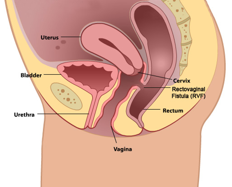 الناسور المهبلي: الأسباب والأعراض والتشخيص والعلاج - ثقب أو قناة تتشكل بين عضوين في الجسم، أو بين عضو في الجسم والجلد - Vaginal Fistula