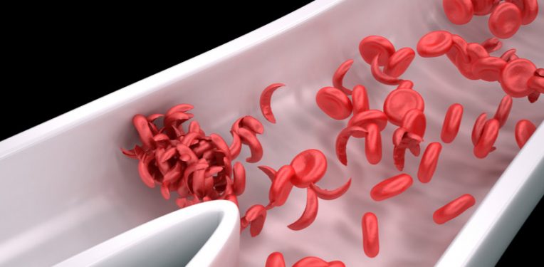 فقر الدم المنجلي: الأسباب والأعراض والتشخيص والعلاج sickle cell anemia أو داء الخلايا المنجلية SCD كريات الدم الحمراء RBCs