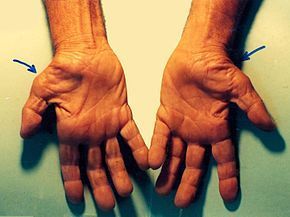 أسباب متلازمة النفق الرسغي علاج متلازمة النفق الرسغي الأسباب والأعراض والتشخيص والعلاج العصب الناصف في الرسغ راحة اليد الأصابع