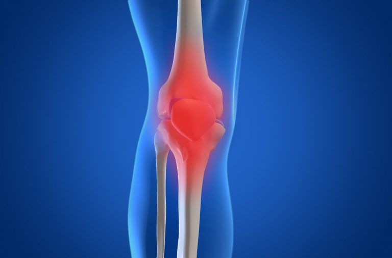 osteoarthritis