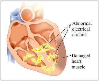 أسباب متلازمة بروغادا علاج متلازمة بروغادا الأسباب والأعراض والتشخيص والعلاج الإشارات الكهربائية ضمن العضلة القلبية القلب