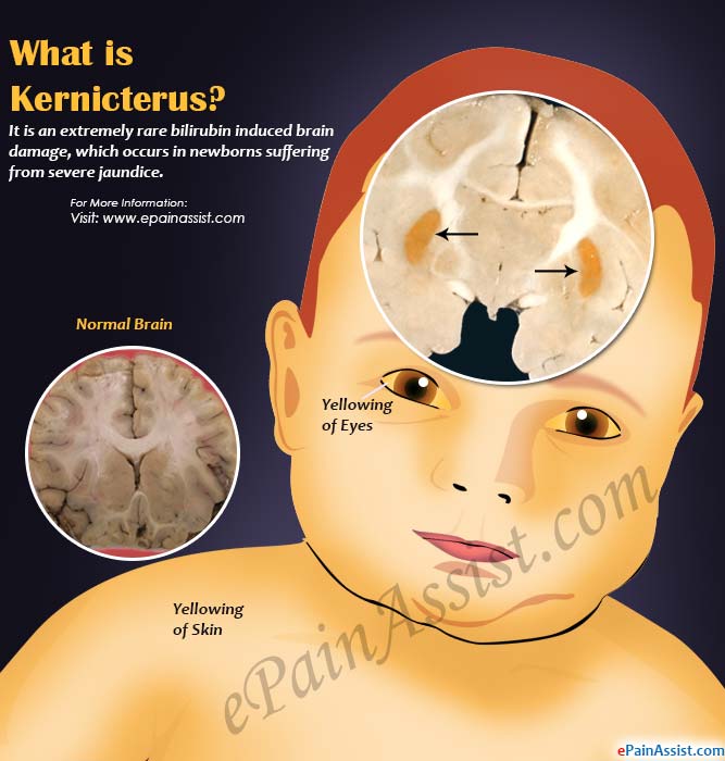  اليرقان النووي: الأسباب والأعراض والتشخيص والعلاج - أحد أنواع تخرب الدماغ التي تشاهَد غالبًا عند الأطفال - التراكم الزائد للبيلروبين Bilirubin في الدماغ