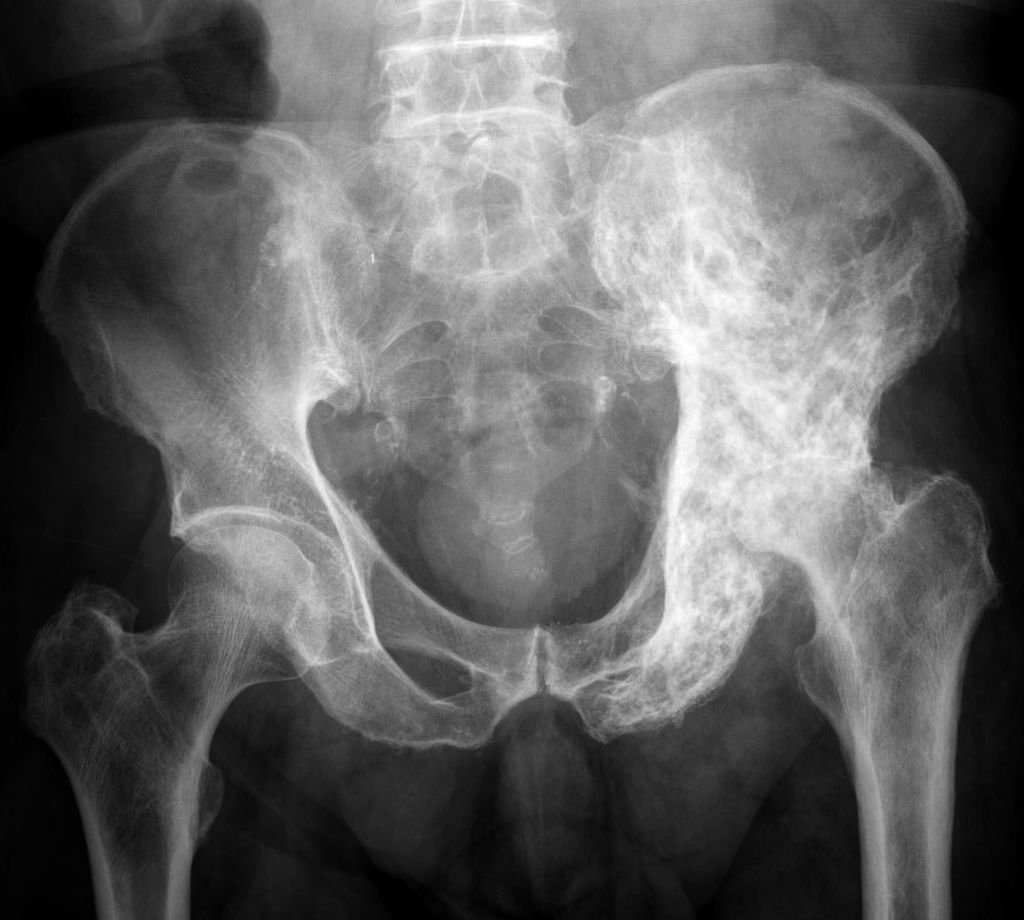 داء باجيت Paget's disease أكثر أنواع أمراض العظام شيوعًا بعد هشاشة العظام اضطراب في عملية إعادة تشكيل العظم ارتشاف الكالسيوم