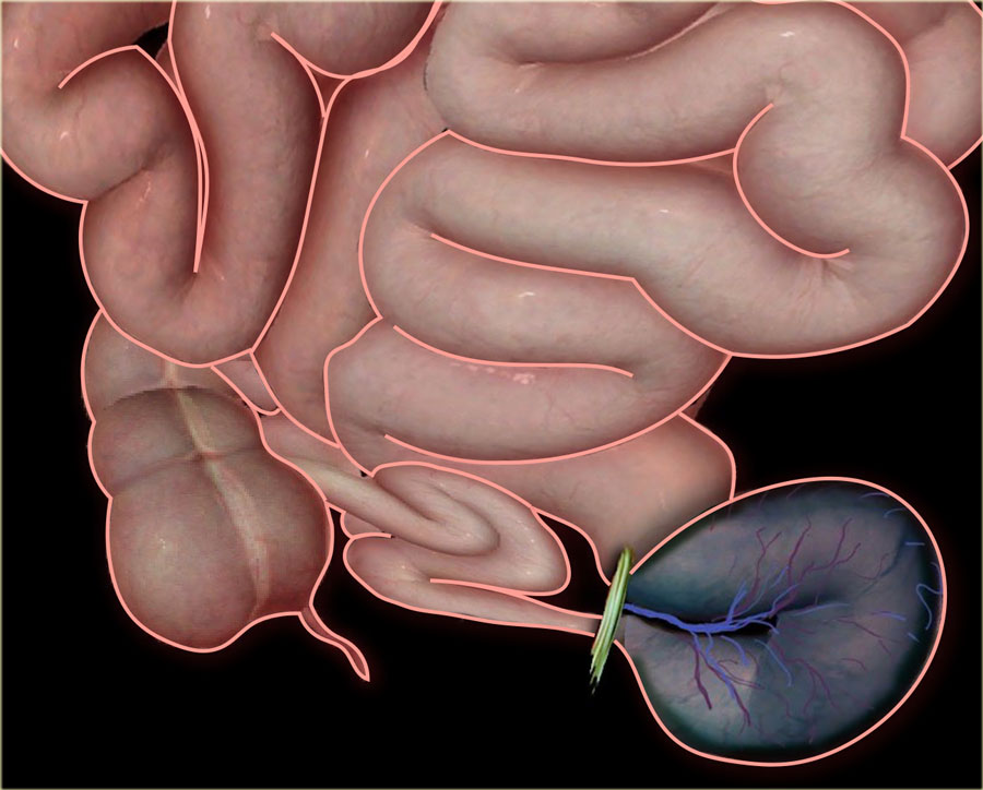 انسداد الأمعاء الدقيقة: الأسباب والأعراض والتشخيص والعلاج Bowel Obstruction هو انسداد جزئي أو كامل في الأمعاء الدقيقة الأمعاء الغليظة