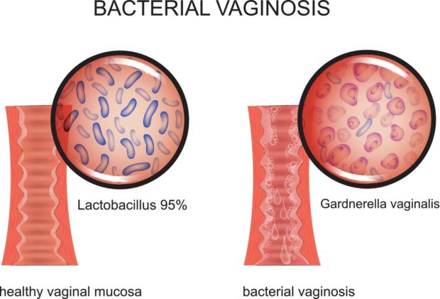 التهاب المهبل الجرثومي: الأسباب والأعراض والتشخيص والعلاج - Bacterial Vaginosis - يحتوي مهبل المرأة طبيعيًّا على أنواع مختلفة من الجراثيم