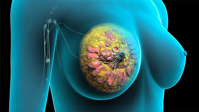 الأتيزوليزوماب سرطان الثدي العلاج الخلايا