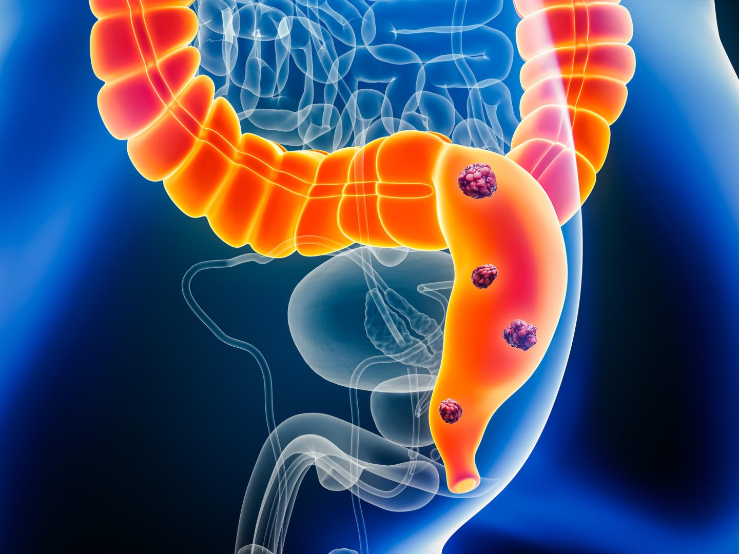 ما أهمية النظام الغذائي في تطوير سرطان القولون والمستقيم؟