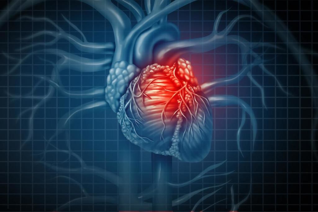 النوبة القلبية أو احتشاء عضلة القلب الأسباب والأعراض والتشخيص والعلاج انغلاق الشرايين التاجية موت عضلة القلب تخثر الصفيحات الدموية