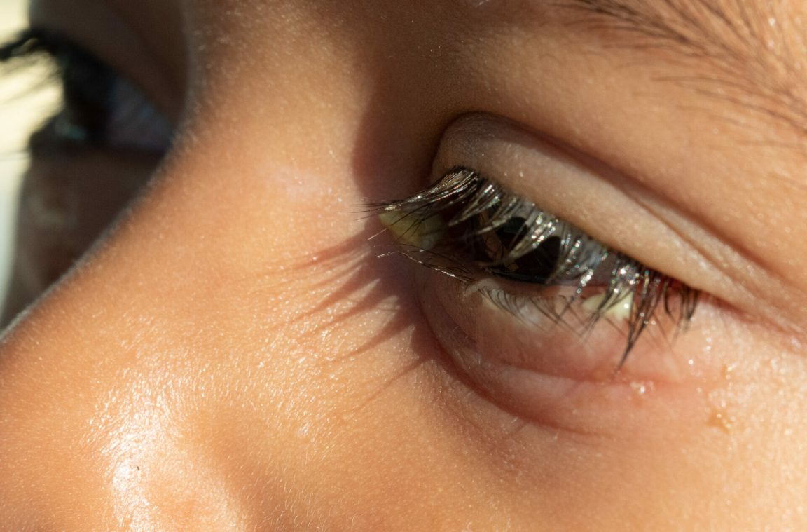 why-your-eyes-are-crusty-in-the-morning-healthnews