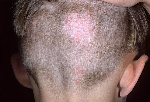 ما هو مرض القوباء الحلقية الفطار الجلدي بقع على الجلد طفيليات فطريات فروة الرأس القدمين، اللحية المنطقة الإربية الأسباب الأعراض التشخيص العلاج