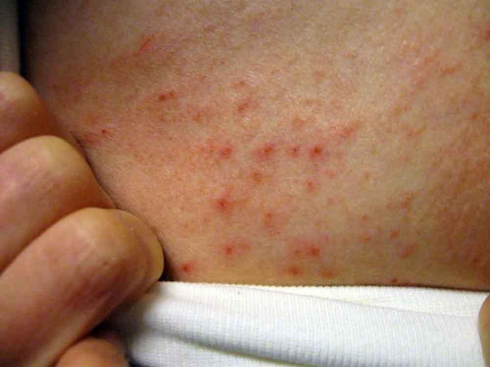 التهاب الجلد الهربسي (حلئي) الشكل الأسباب والأعراض والتشخيص والعلاج Dermatitis herpetiformis هو طفح جلدي ينتج بسبب الحساسية تجاه الغلوتين
