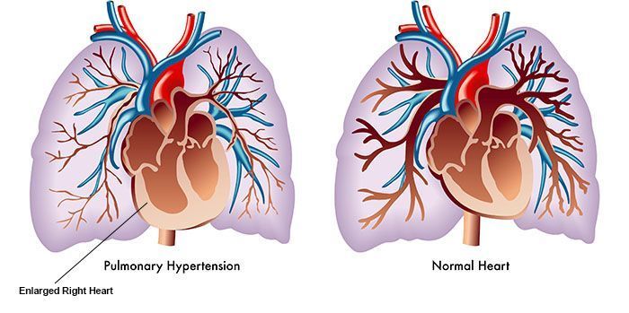 أعراض مرض القلب الرئوي علاج مرض القلب الرئوي الأسباب والأعراض والتشخيص والعلاج ارتفاع ضغط الدم ضغط الدم المرتفع في الشرايين الرئوية 