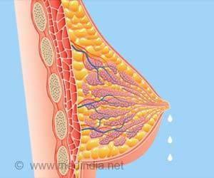 ثر اللبن Galactorrhea: الأسباب والأعراض والتشخيص والعلاج إفراز الحليب عند الرجال أو النساء غير المرضعات إفراز هرمون البرولاكتين