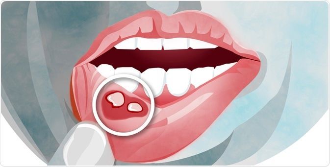 التهاب الفم: الأسباب والأعراض والتشخيص والعلاج التهاب يصيب الفم ويؤثر على الأغشية المخاطية الغشاء الرقيق المبطن للفم الجهاز الهضمي 