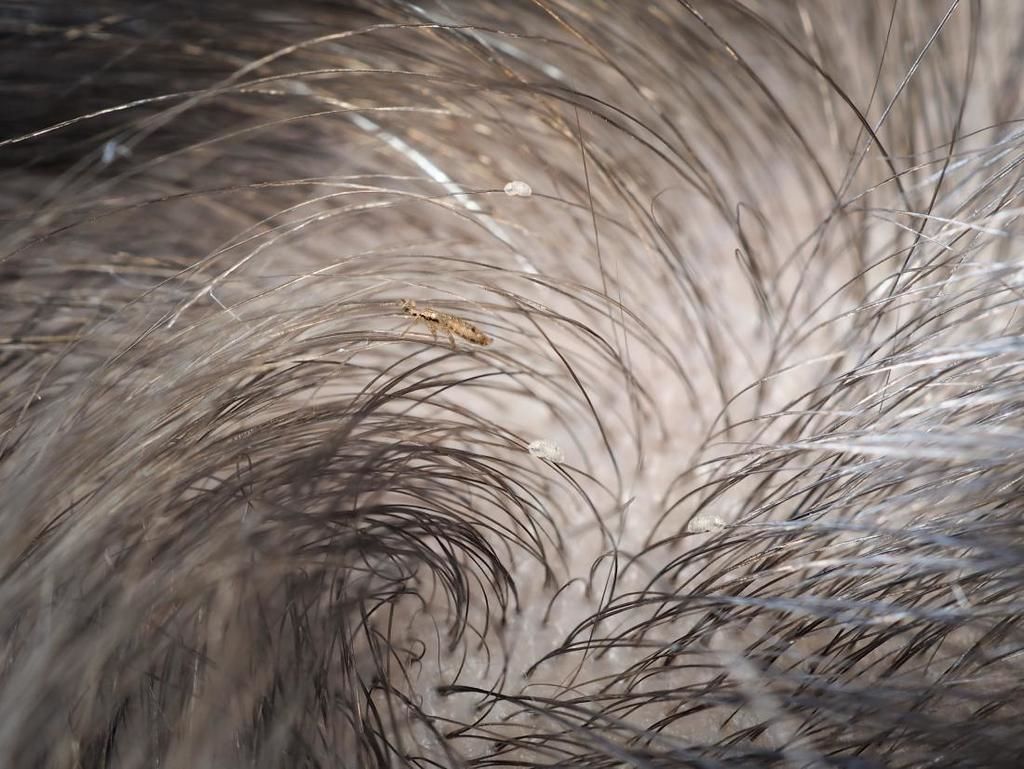 شكل القمل - كيف نفرق بين قمل الرأس و القشرة أعراض القشرة أعراض قمل الرأس طريقة علاج قشرة الشعر كيفية علاج القمل الوقاية من الإصابة بالقمل