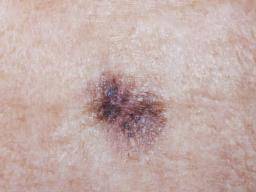 الميلانوما Melanoma – الورم الميلانيني الأسباب والأعراض والتشخيص والعلاج أكثر أنواع سرطان الجلد شيوعًا الوقاية من سرطان الجلد 