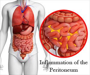التهاب الصفاق peritonitis: الأسباب والأعراض والتشخيص والعلاج طبقة رقيقة من نسيج يغطي ما داخل البطن عدوى فطرية أو جرثومية البريتوان 