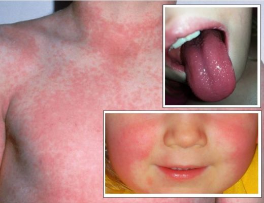 الحمى القرمزية: الأسباب والأعراض والتشخيص والعلاج ما هي أعراض عدوى العقديات على الأطفال أسباب الإصابة بالحمى التخفيف من الأعراض
