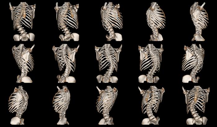  الجنف: الأسباب والأعراض والتشخيص والعلاج Scoliosis-imaging