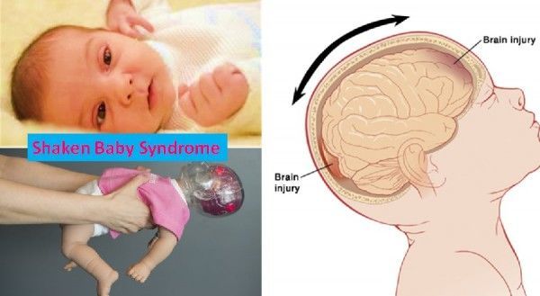 متلازمة هز الرضيع: الأسباب والأعراض والتشخيص والعلاج أذية دماغية خطيرة ناجمة عن هز الطفل الرضيع بشكل قوي وعنيف Shaken baby syndrome