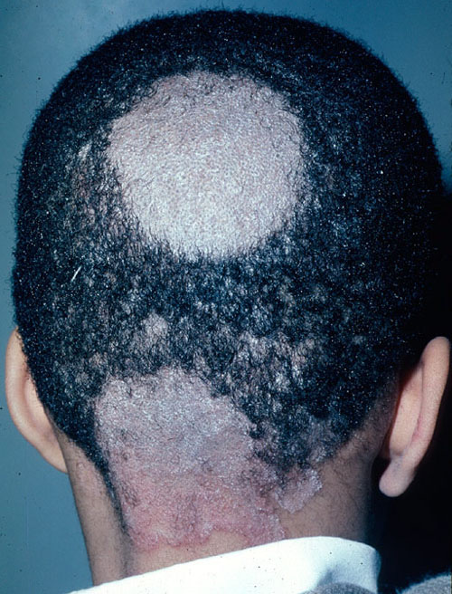 سعفة الرأس: الأسباب والأعراض والتشخيص والعلاج - عدوى فطرية تُصيب فروة الرأس وتؤثر عليها وعلى الشعر - بقع جلدية حاكّة متقشرة