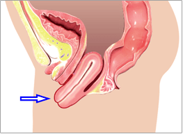 تدلي أعضاء الحوض Pelvic organ prolapse الأسباب والأعراض والتشخيص والعلاج ضعف الأنسجة والعضلات الداعمة لأعضاء الحوض المثانة الرحم عنق الرحم المهبل المستقيم