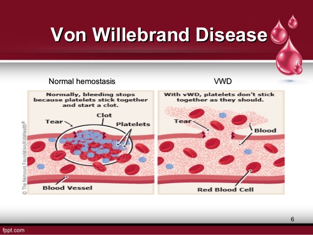 داء فون ويلبراند: الأسباب والأعراض والتشخيص والعلاج - ينتج عن عوز عامل فون ويلبراند (VWF) - بروتين يساعد الدم على التخثر - الاضطرابات النزفية