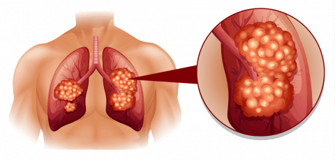 ورم المتوسطة الخبيث: الأسباب والأعراض والتشخيص والعلاج خلايا سرطانية خبيثة في الخلايا المبطِّنة للبطن أو الصدر ألم تحت القفص الصدري